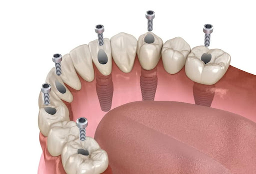 tipos de ortodoncias existentes